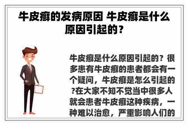 牛皮癣的发病原因 牛皮癣是什么原因引起的？